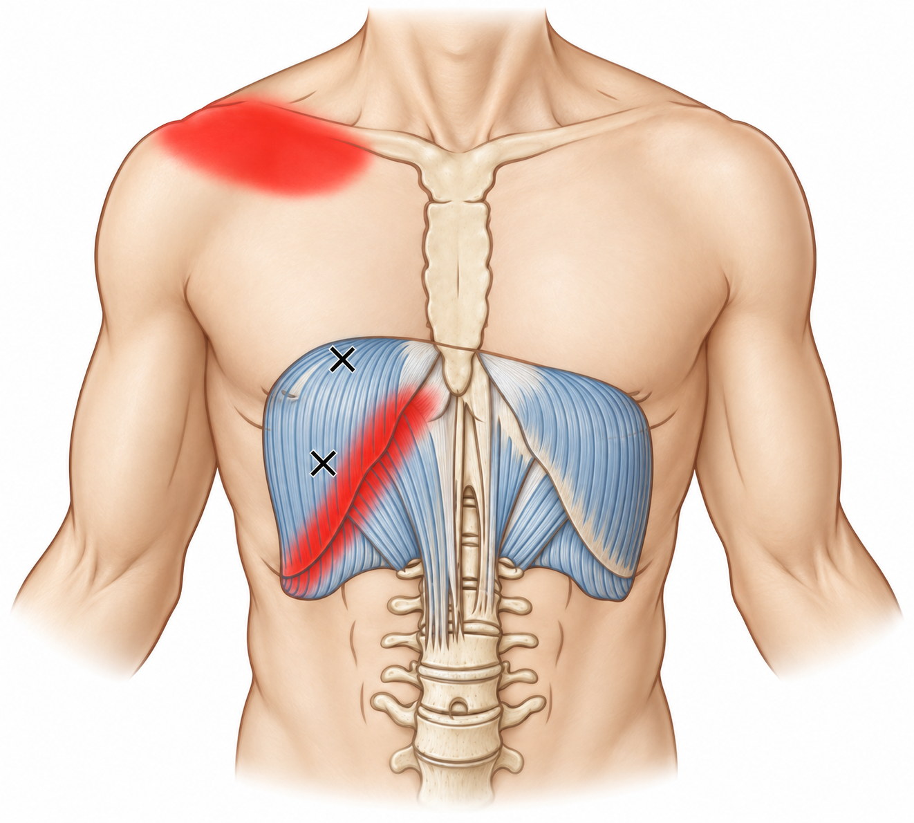 Diaphragm · Anatomy and referred pain 1. Representative source regions. The illustrated markers and pain pattern are not individual assignments to the numbered trigger points.