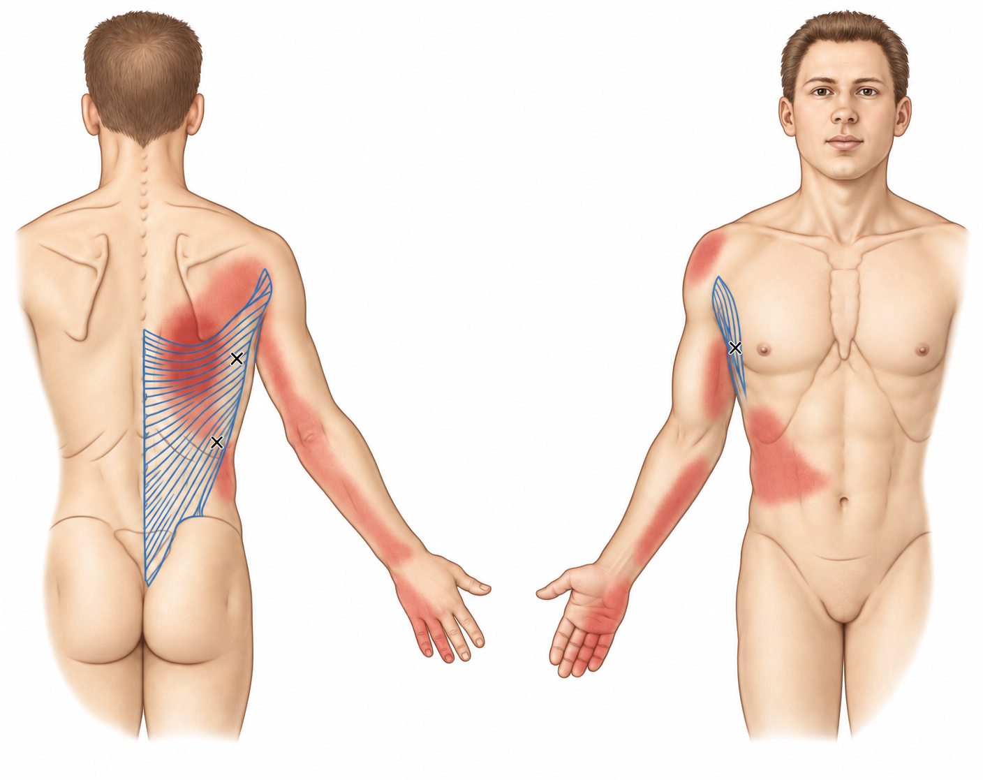 Latissimus Dorsi · Anatomy and referred pain 1. Representative source regions. The illustrated markers and pain pattern are not individual assignments to the numbered trigger points.