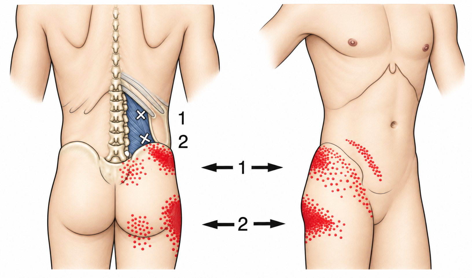 Quadratus Lumborum · Anatomy and referred pain 1. Representative source regions. The illustrated markers and pain pattern are not individual assignments to the numbered trigger points.