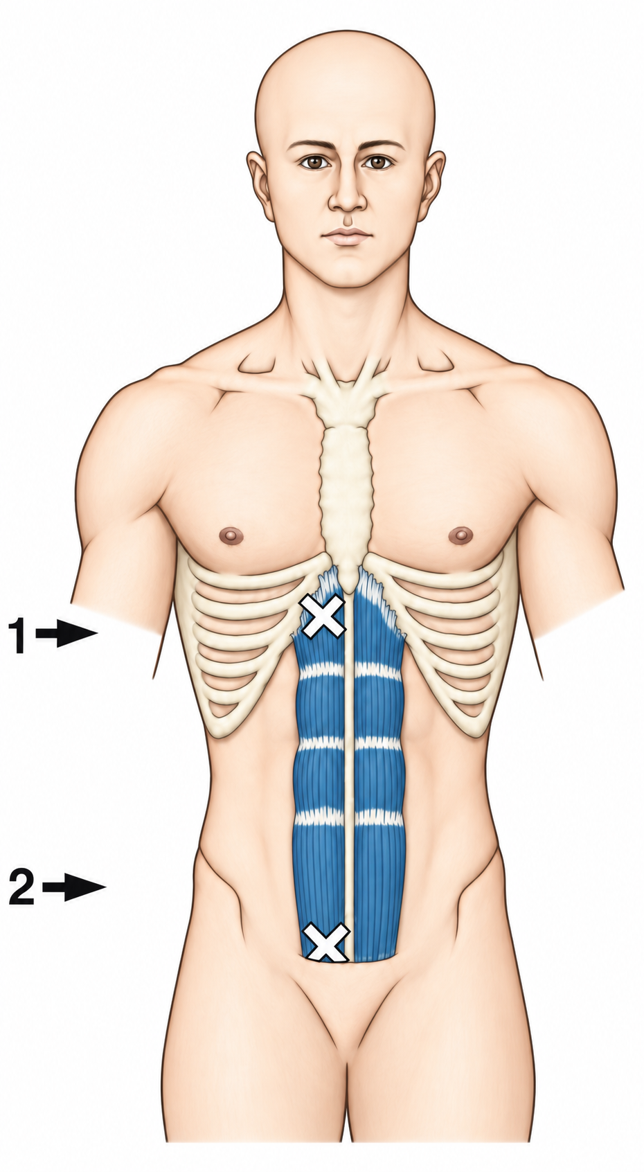 Rectus Abdominis · Trigger-point examples 1. Representative source regions. The illustrated markers and pain pattern are not individual assignments to the numbered trigger points.