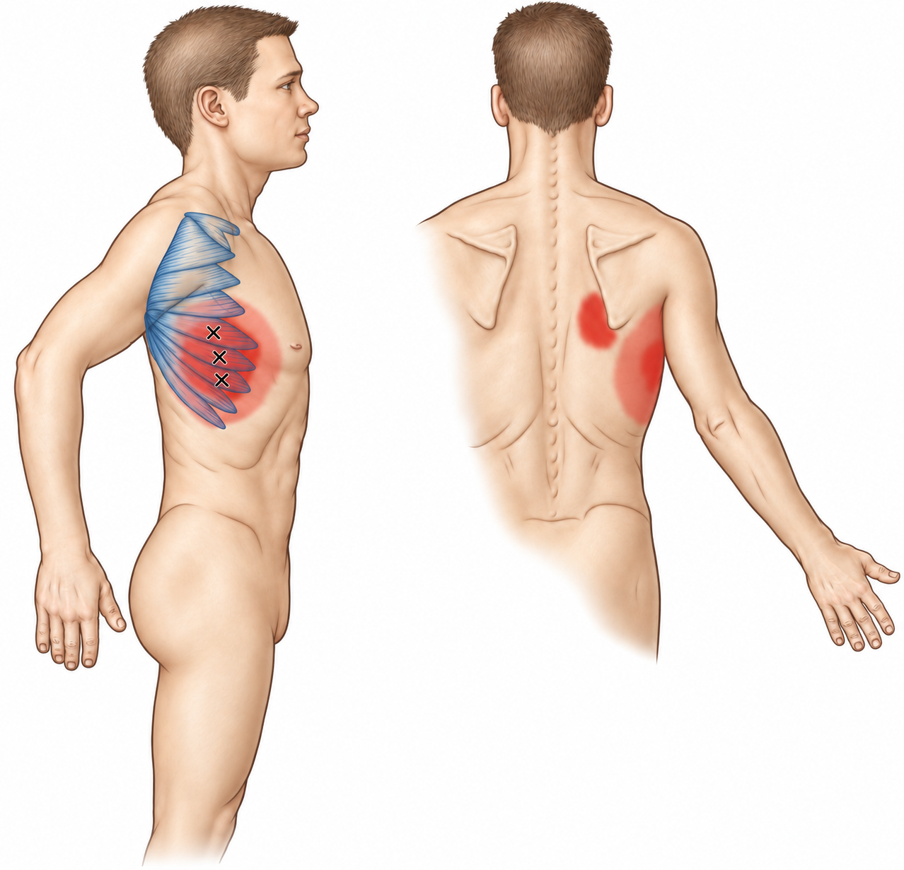 Serratus Anterior · Anatomy and referred pain 1. Representative source regions. The illustrated markers and pain pattern are not individual assignments to the numbered trigger points.