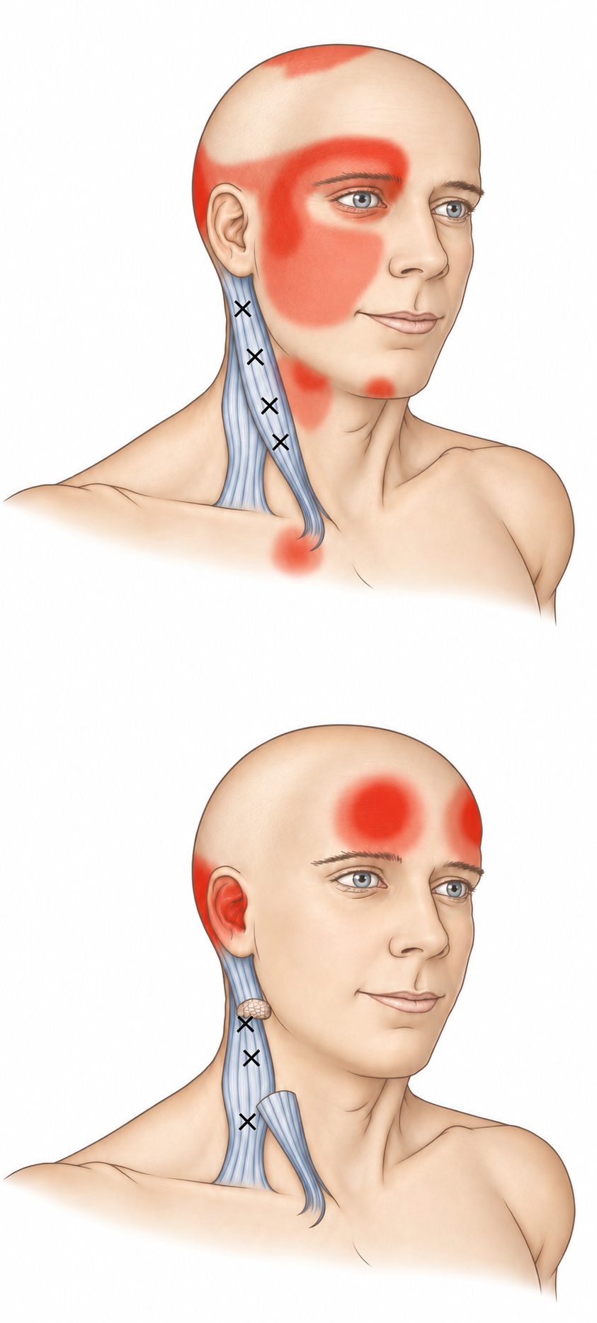 Sternocleidomastoid · Anatomy and referred pain 1. Representative source regions. The illustrated markers and pain pattern are not individual assignments to the numbered trigger points.
