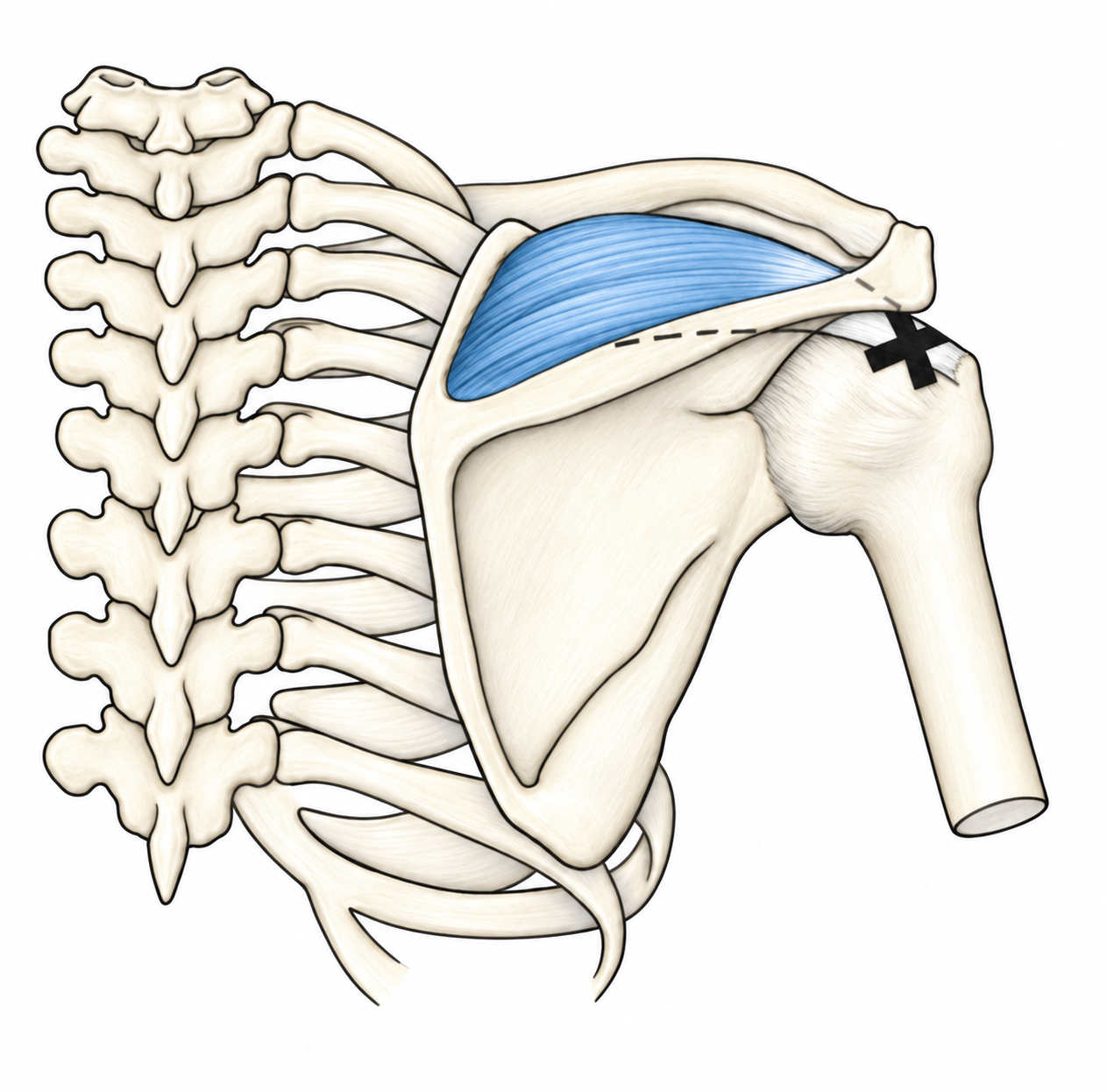 Supraspinatus · Trigger-point examples 1. Representative source regions. The illustrated markers and pain pattern are not individual assignments to the numbered trigger points.