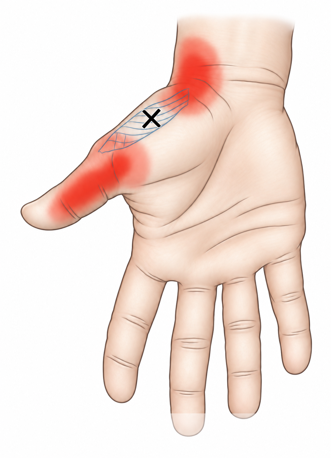 Thenar Eminence · Anatomy and referred pain 1. Representative source regions. The illustrated markers and pain pattern are not individual assignments to the numbered trigger points.