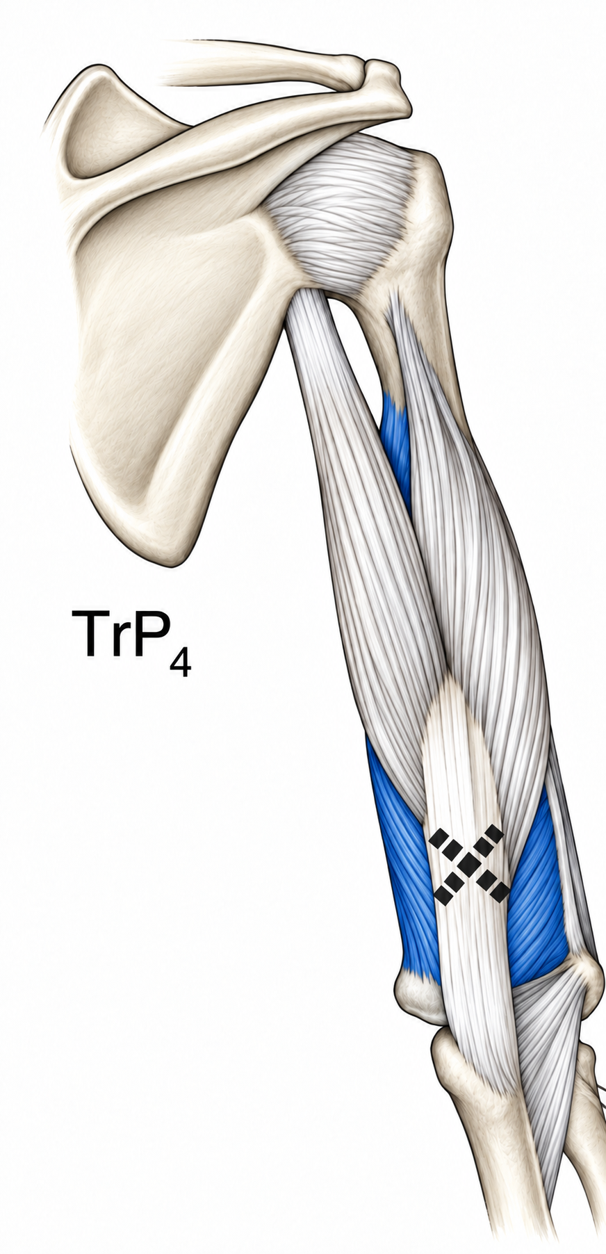 Triceps Brachii · Trigger-point examples 1. Representative source regions. The illustrated markers and pain pattern are not individual assignments to the numbered trigger points.