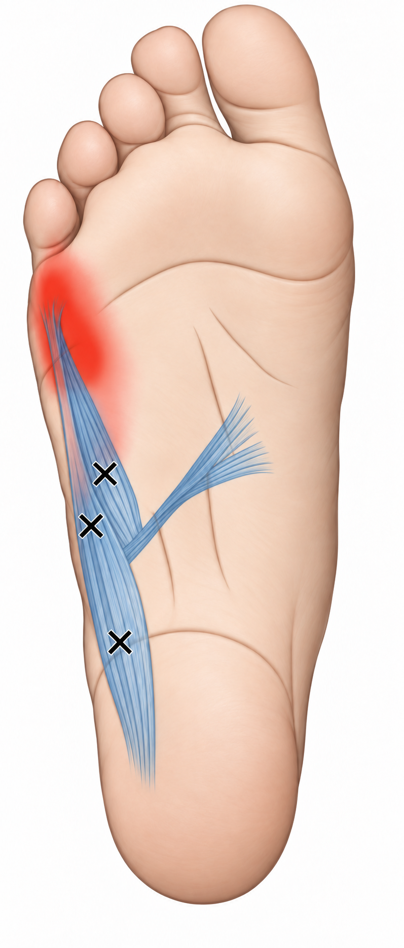 Abductor Digiti Minimi · Anatomy and referred pain 1. Representative source regions. The illustrated markers and pain pattern are not individual assignments to the numbered trigger points.