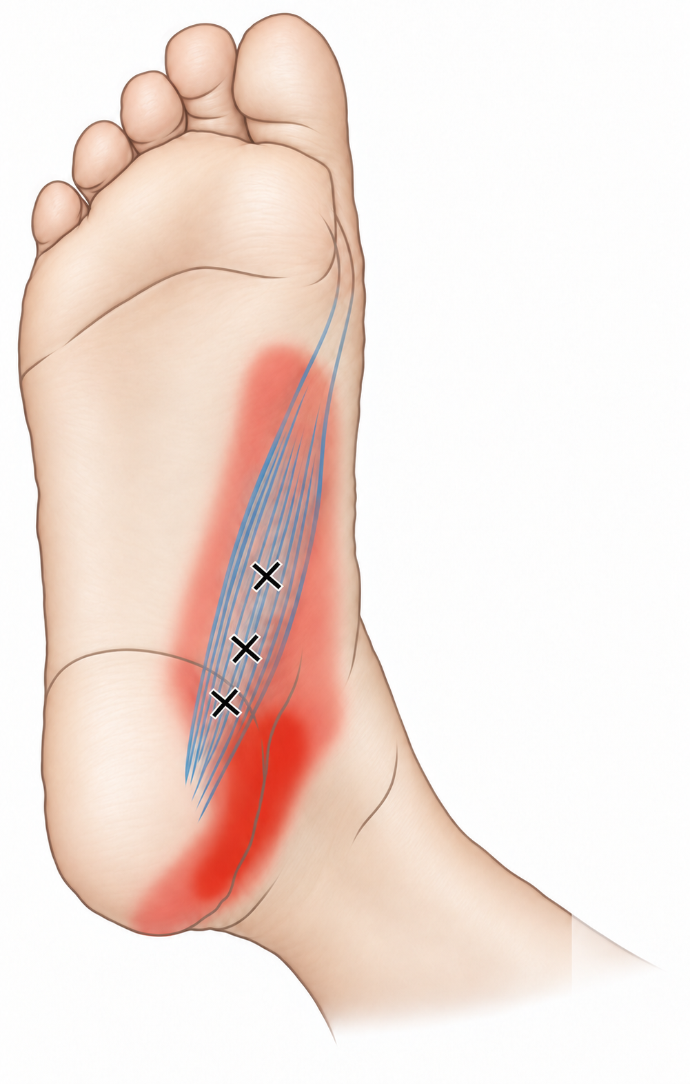 Abductor Hallucis · Anatomy and referred pain 1. Representative source regions. The illustrated markers and pain pattern are not individual assignments to the numbered trigger points.