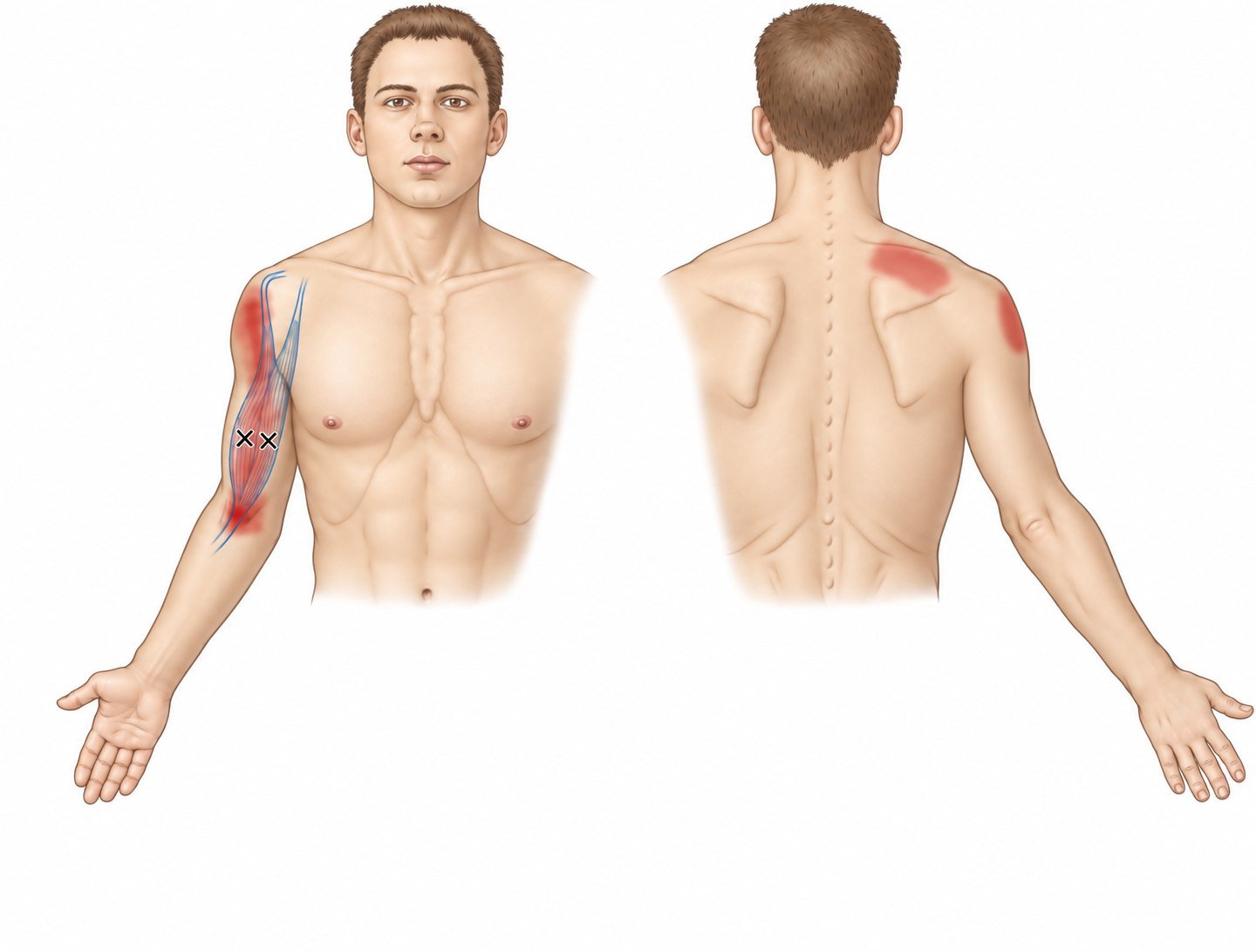 Biceps Brachii · Anatomy and referred pain 1. Representative source regions. The illustrated markers and pain pattern are not individual assignments to the numbered trigger points.