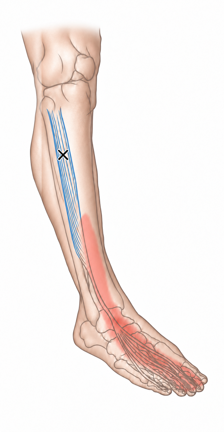 Extensor Digitorum Longus · Anatomy and referred pain 1. Representative source regions. The illustrated markers and pain pattern are not individual assignments to the numbered trigger points.