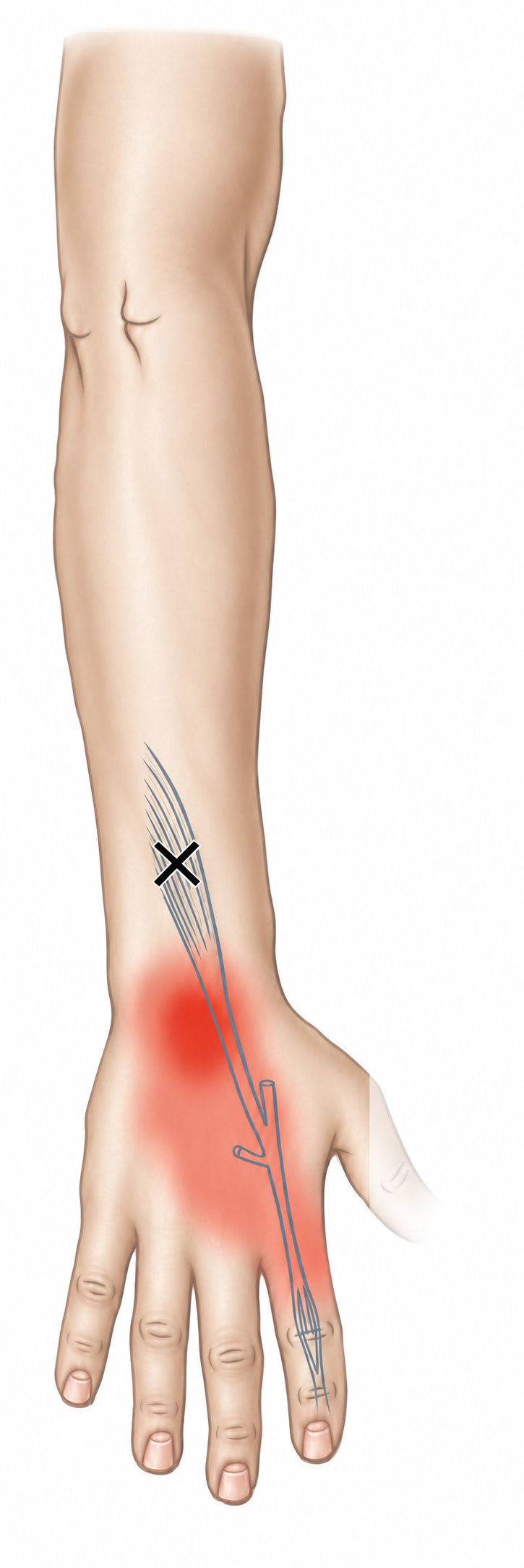 Extensor Indicis · Anatomy and referred pain 1. Representative source regions. The illustrated markers and pain pattern are not individual assignments to the numbered trigger points.