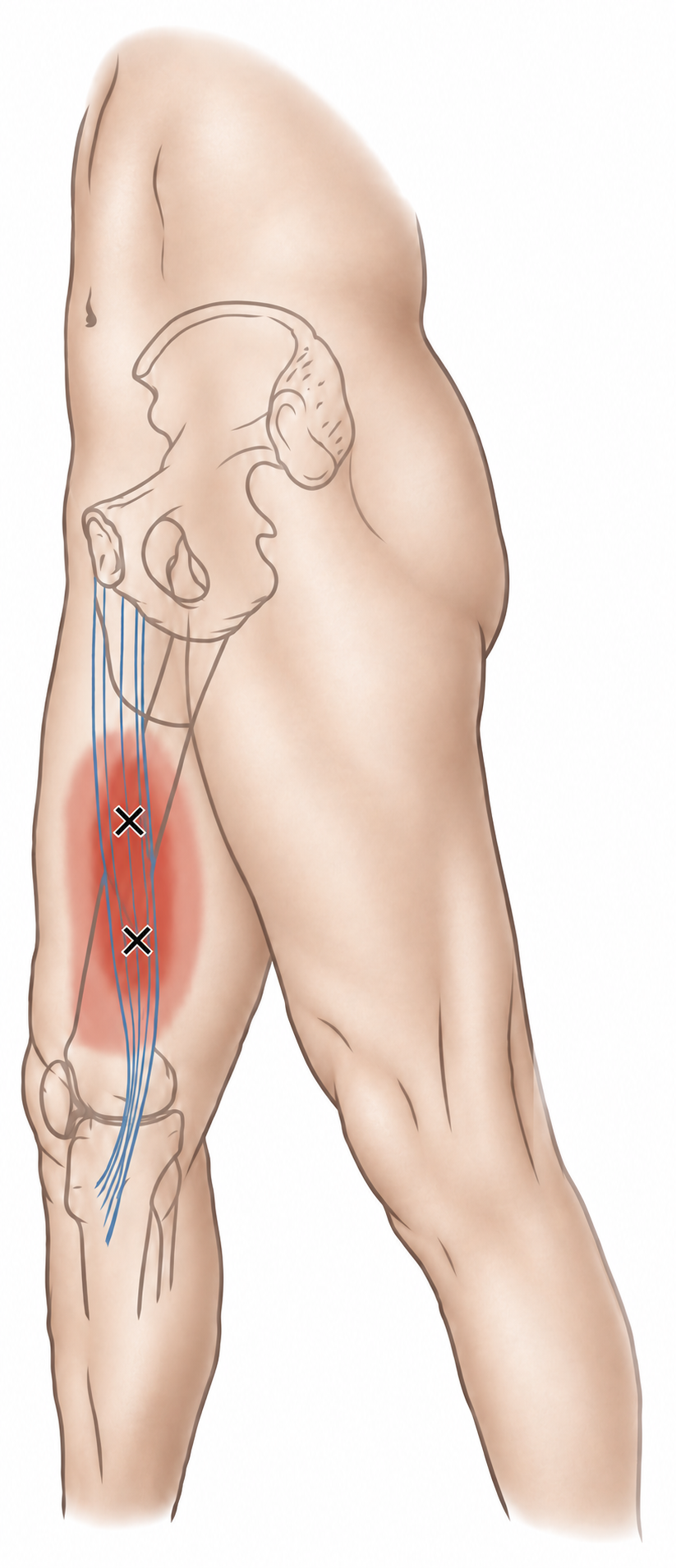 Gracilis · Anatomy and referred pain 1. Representative source regions. The illustrated markers and pain pattern are not individual assignments to the numbered trigger points.