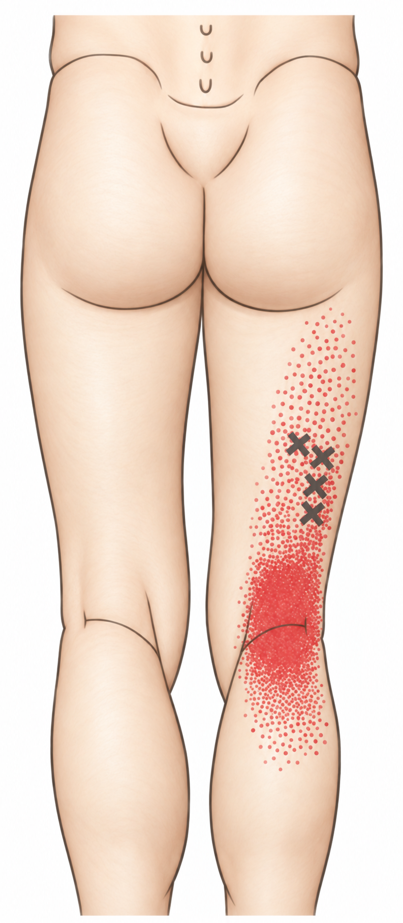 Hamstrings · Anatomy and referred pain 1. Representative source regions. The illustrated markers and pain pattern are not individual assignments to the numbered trigger points.