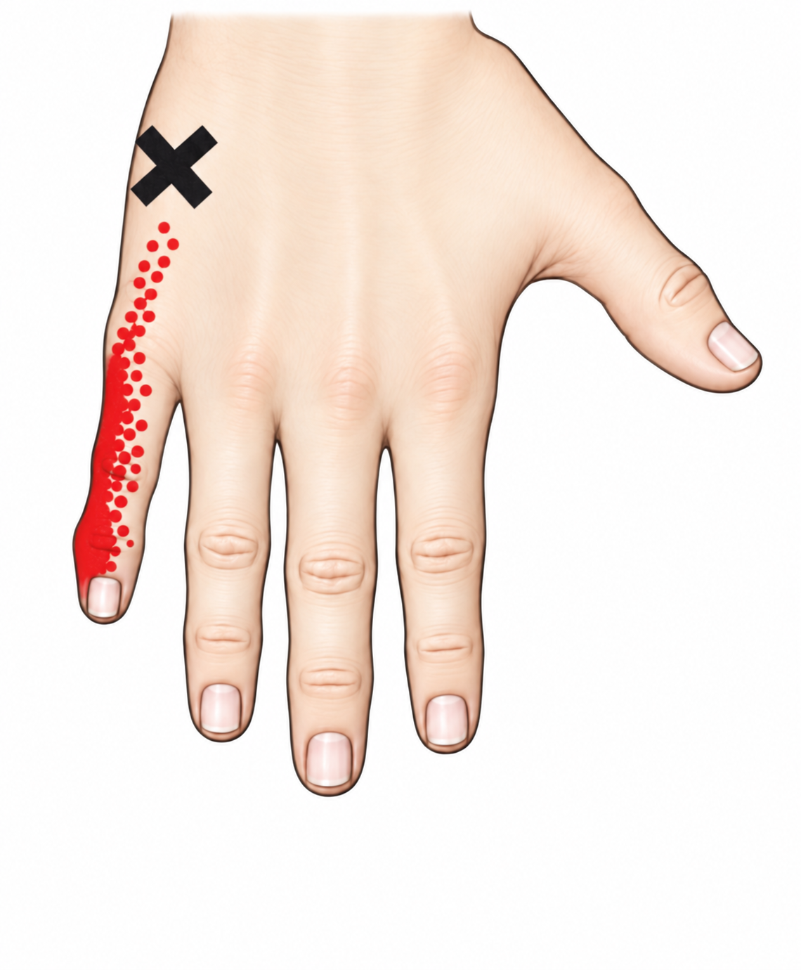 Hypothenar Eminence · Anatomy and referred pain 1. Representative source regions. The illustrated markers and pain pattern are not individual assignments to the numbered trigger points.
