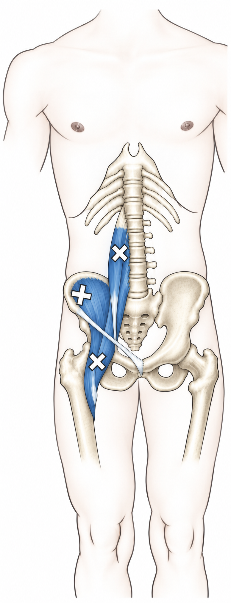Iliopsoas · Trigger-point examples 1. Representative source regions. The illustrated markers and pain pattern are not individual assignments to the numbered trigger points.