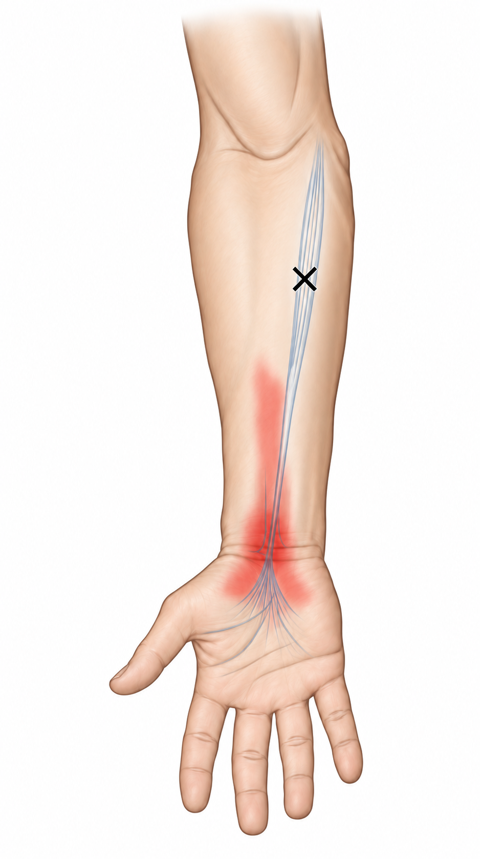 Palmaris Longus · Anatomy and referred pain 1. Representative source regions. The illustrated markers and pain pattern are not individual assignments to the numbered trigger points.