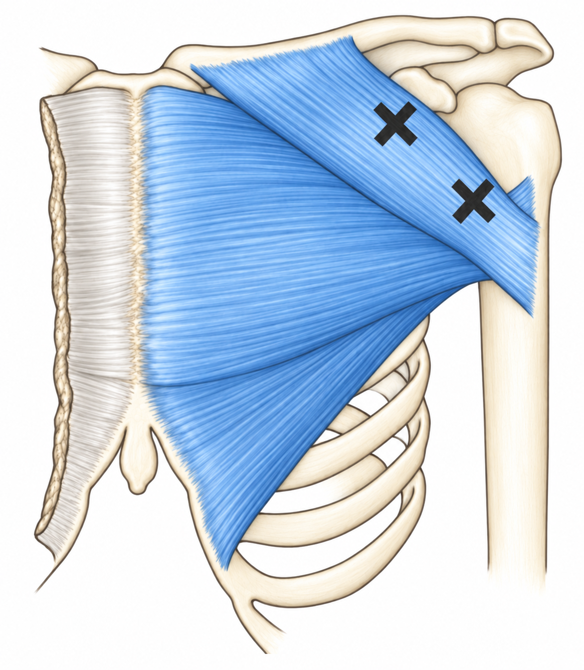 Pectoralis Major · Trigger-point examples 1. Representative source regions. The illustrated markers and pain pattern are not individual assignments to the numbered trigger points.