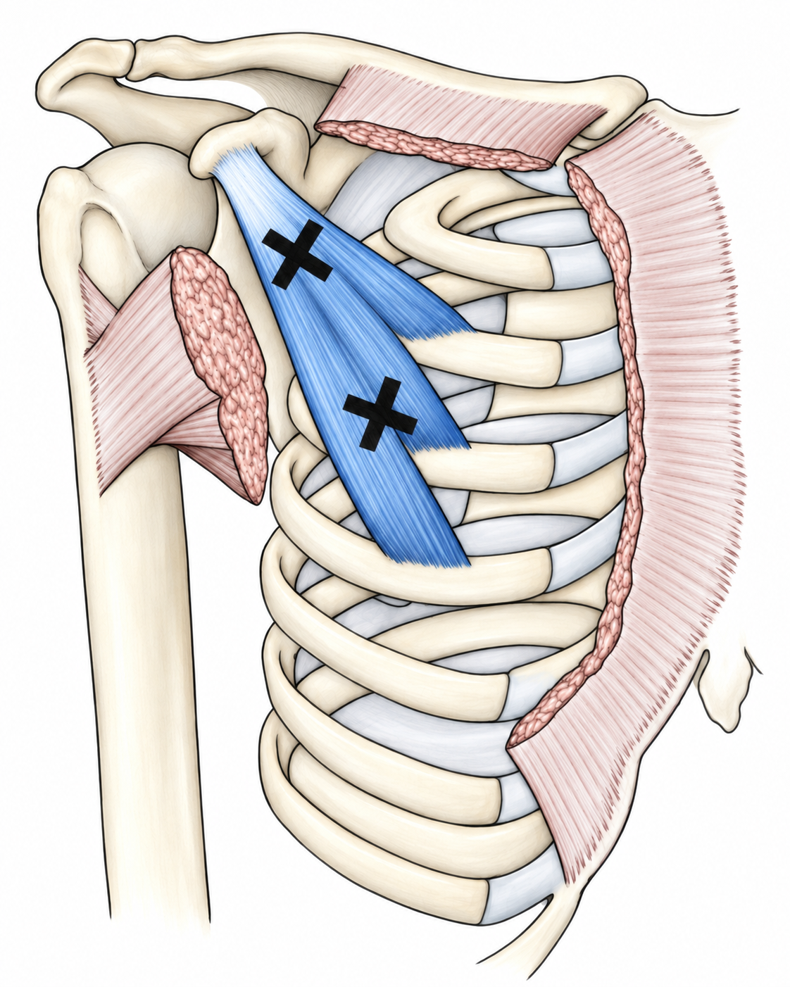 Pectoralis Minor · Trigger-point examples 1. Representative source regions. The illustrated markers and pain pattern are not individual assignments to the numbered trigger points.
