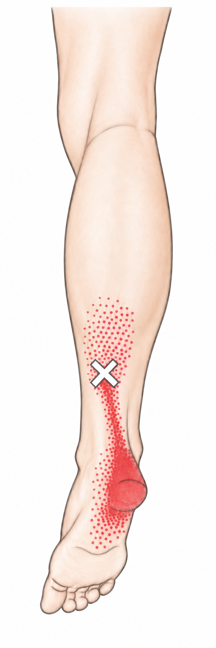 Soleus · Anatomy and referred pain 1. Representative source regions. The illustrated markers and pain pattern are not individual assignments to the numbered trigger points.
