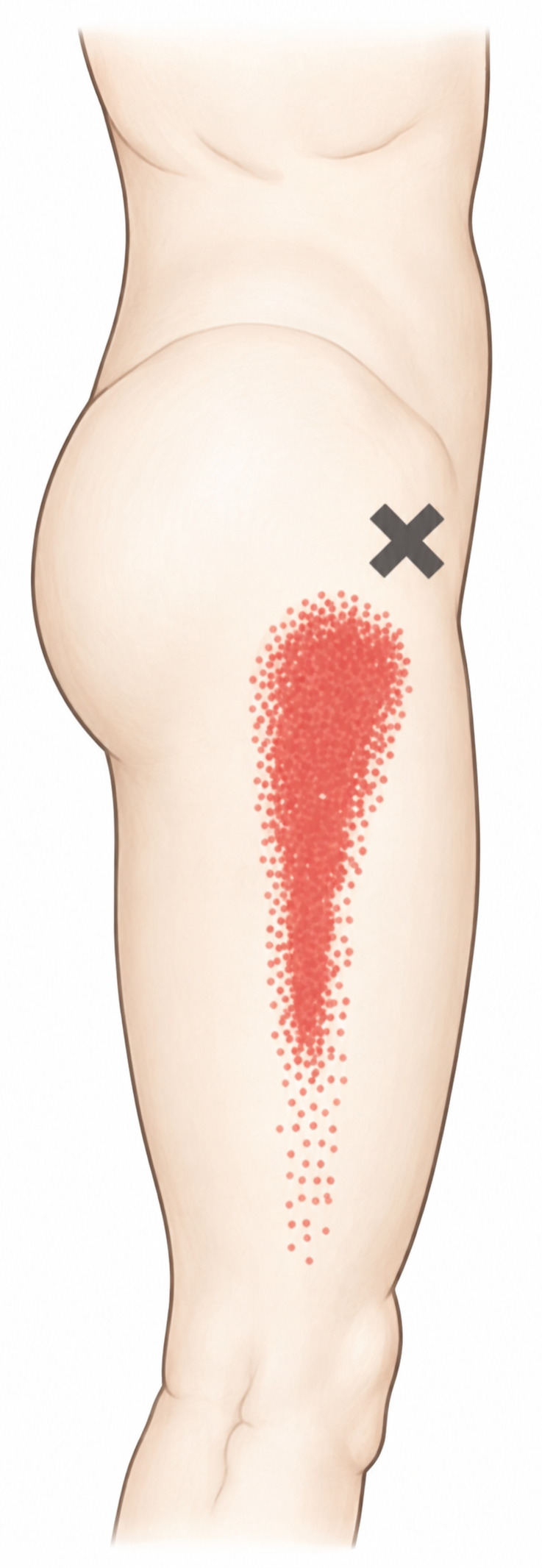 Tensor Fasciae Latae · Anatomy and referred pain 1. Representative source regions. The illustrated markers and pain pattern are not individual assignments to the numbered trigger points.