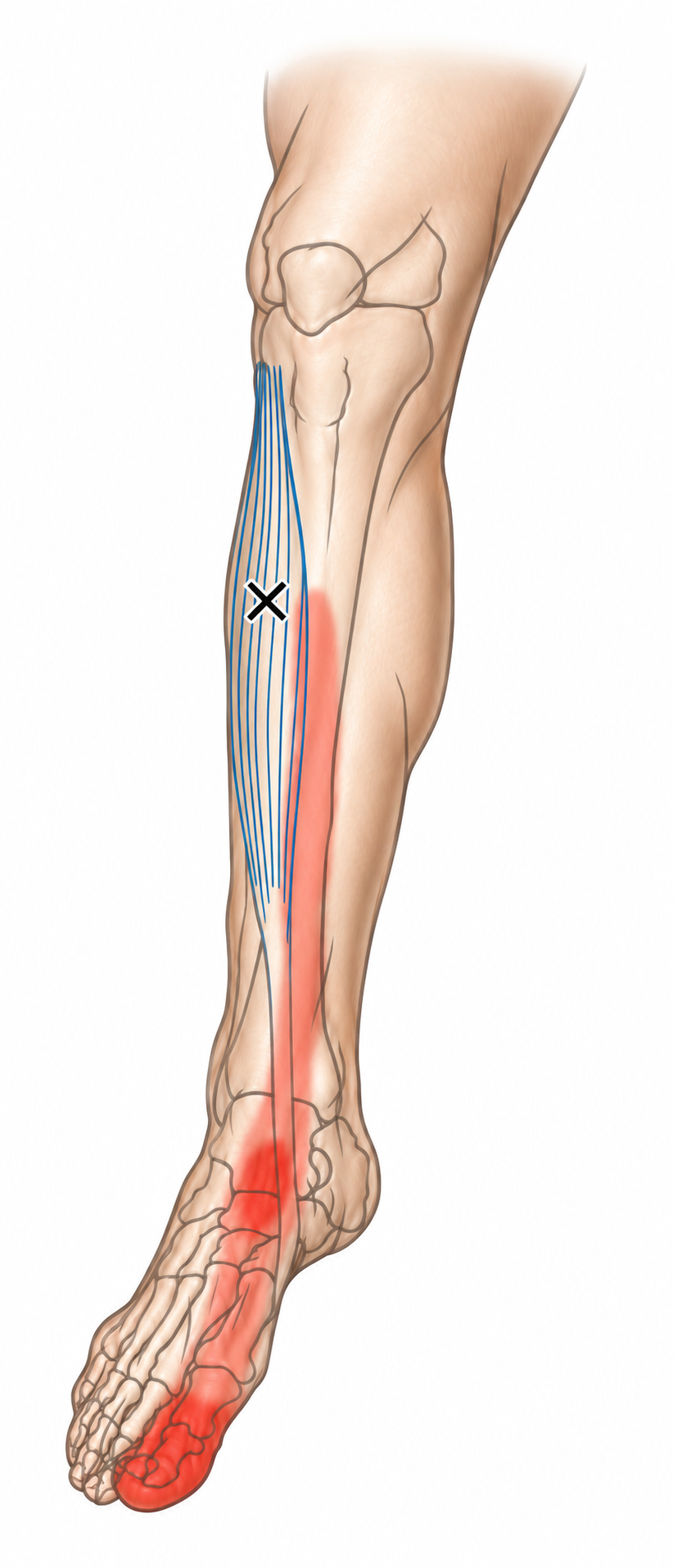 Tibialis Anterior · Anatomy and referred pain 1. Representative source regions. The illustrated markers and pain pattern are not individual assignments to the numbered trigger points.