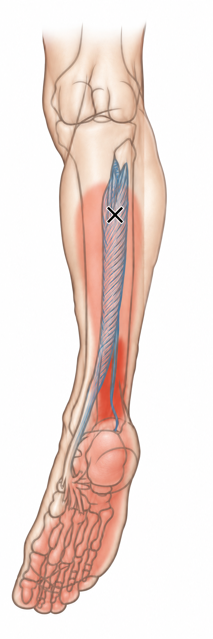 Tibialis Posterior · Anatomy and referred pain 1. Representative source regions. The illustrated markers and pain pattern are not individual assignments to the numbered trigger points.