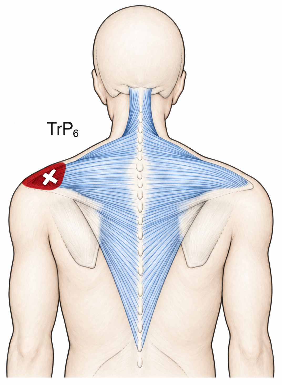 Trapezius · Anatomy and referred pain 1. Representative source regions. The illustrated markers and pain pattern are not individual assignments to the numbered trigger points.