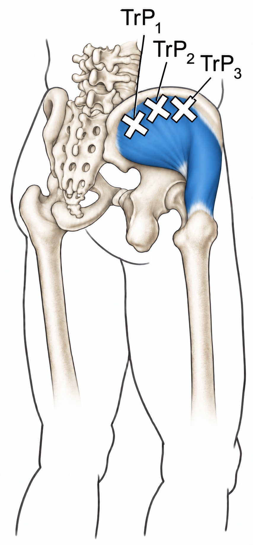 Gluteus Medius · Trigger-point examples 1. Representative source regions. The illustrated markers and pain pattern are not individual assignments to the numbered trigger points.