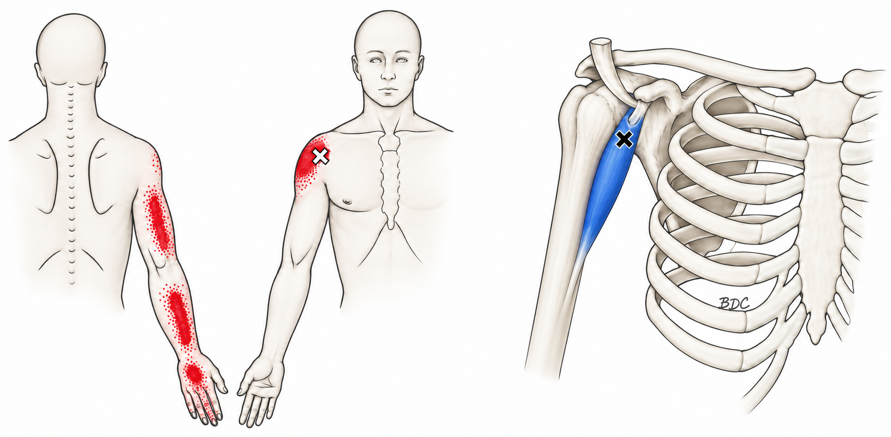 Coracobrachialis · Regional source example. Right coracobrachialis: one source example shown in anatomical and surface views, with its regional pain pattern. Travell and Simons, Fig. 29.1, p. 639. Regional illustration; not an individual map of a selected numbered point.