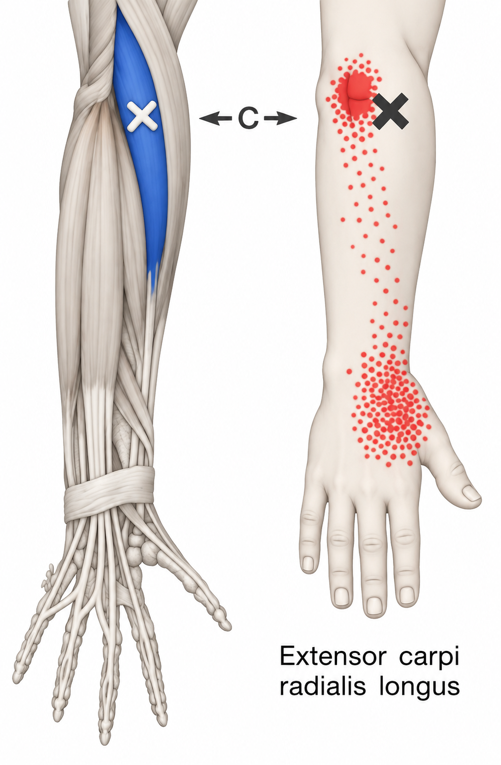 Extensor Carpi Radialis Longus · Regional source example. Right extensor carpi radialis longus: the source anatomical example and surface referral pattern from panel C. Travell and Simons, Fig. 34.1C, p. 692. Regional illustration; not an individual map of a selected numbered point.