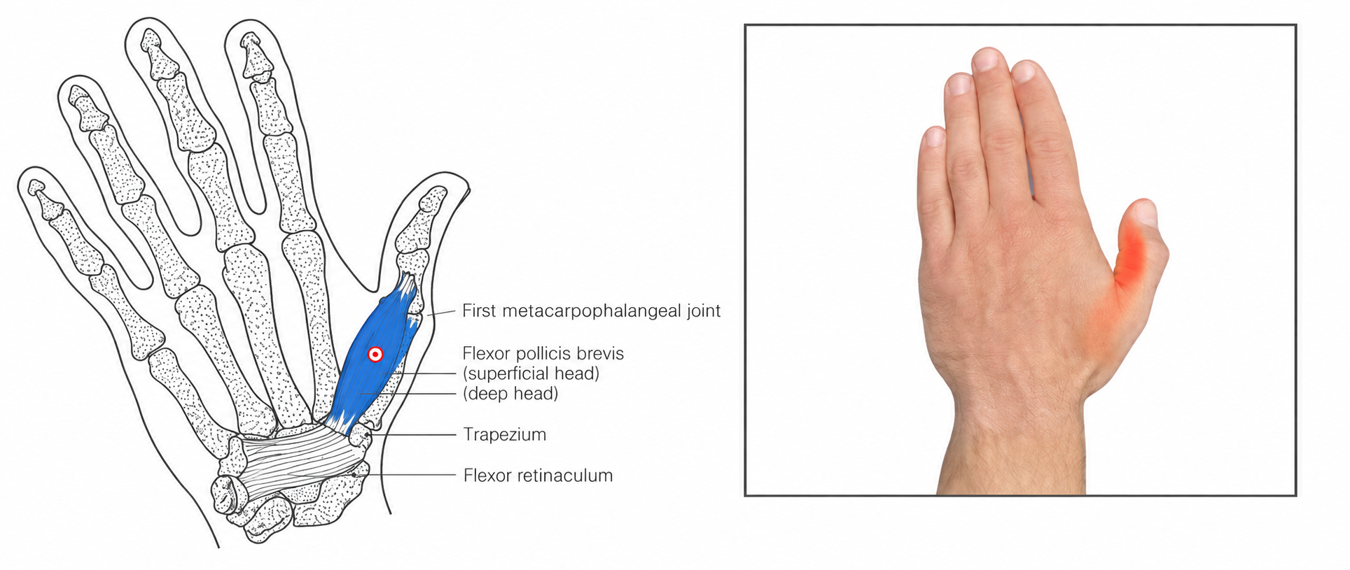 Flexor Pollicis Brevis · Regional source example. One thenar trigger-region example and a separate thumb-only referral photograph from Kostopoulos and Rizopoulos, printed p. 152. The schematic and photograph retain their different source projections; they do not identify separate muscle heads or individual numbered points.