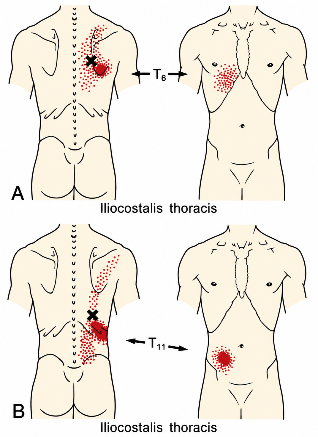 Iliocostalis Thoracis · Regional source examples A/B. Right iliocostalis thoracis examples at the source T6 and T11 levels, with paired posterior and anterior regional pain patterns. Travell and Simons, Fig. 48.1A–B, p. 915. These regional examples are not individual assignments to numbered trigger points.