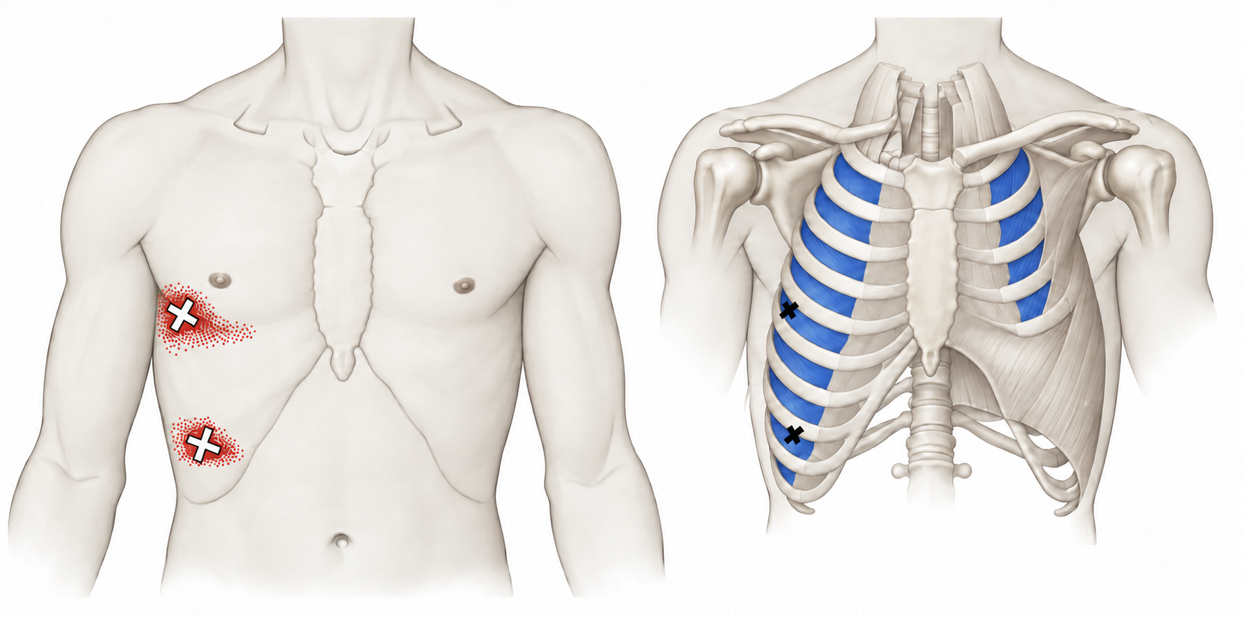 Intercostals · Regional source example. Right intercostal source examples: two separate anterior/lateral chest pain fields and the corresponding source markers. Travell and Simons, Fig. 45.1, p. 863. Regional illustration; not an individual map of a selected numbered point.
