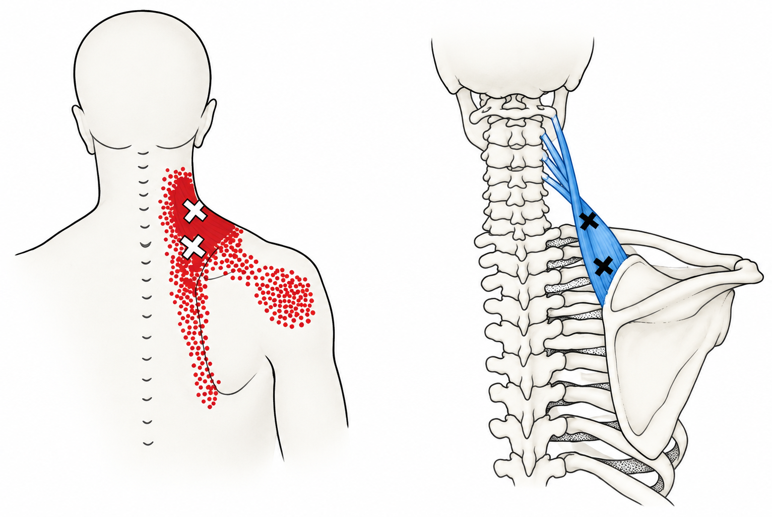 Levator Scapulae · Regional source example. Right levator scapulae: a mid-muscle trigger example and a separate attachment-tenderness region, with the source regional pain pattern. Travell and Simons, Fig. 19.1, p. 492. Regional illustration; not an individual map of a selected numbered point.