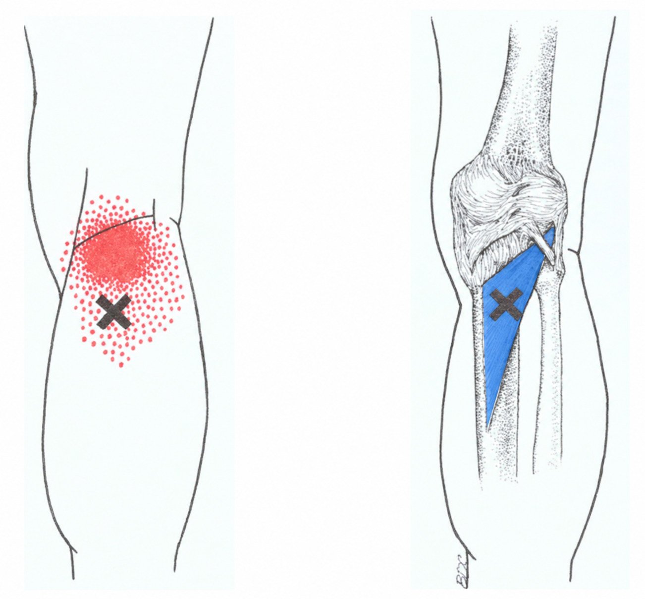 Popliteus · Regional source example. Right popliteus: one source example shown in surface and anatomical views, with its posterior-knee pain pattern. Travell and Simons, Fig. 17.1, p. 340. Regional illustration; not an individual map of a selected numbered point.