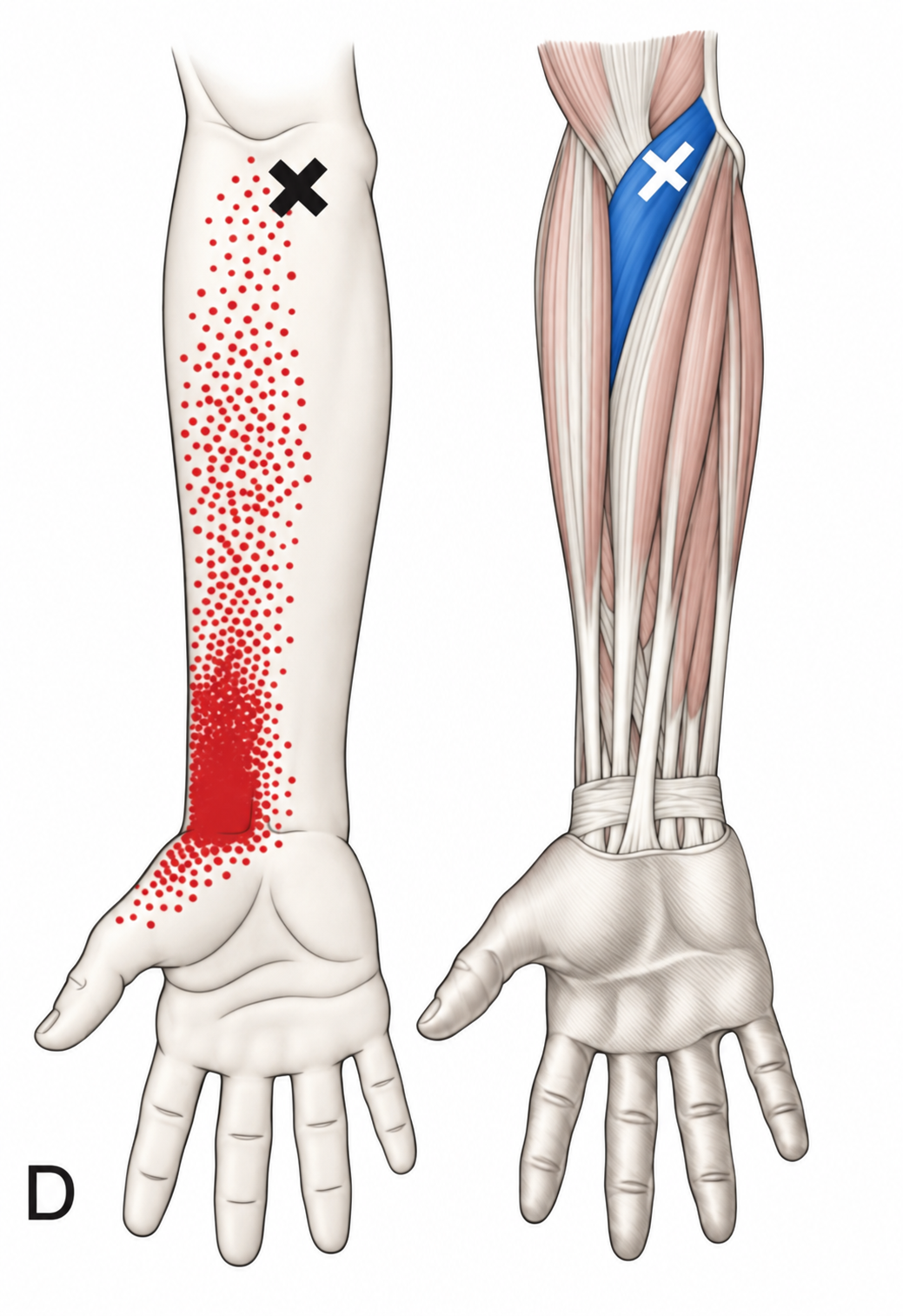 Pronator Teres · Regional source example. Right pronator teres: one proximal source example and its radial wrist/forearm pain pattern. Travell and Simons, Fig. 38.1D, p. 757. Regional illustration; not an individual map of a selected numbered point.