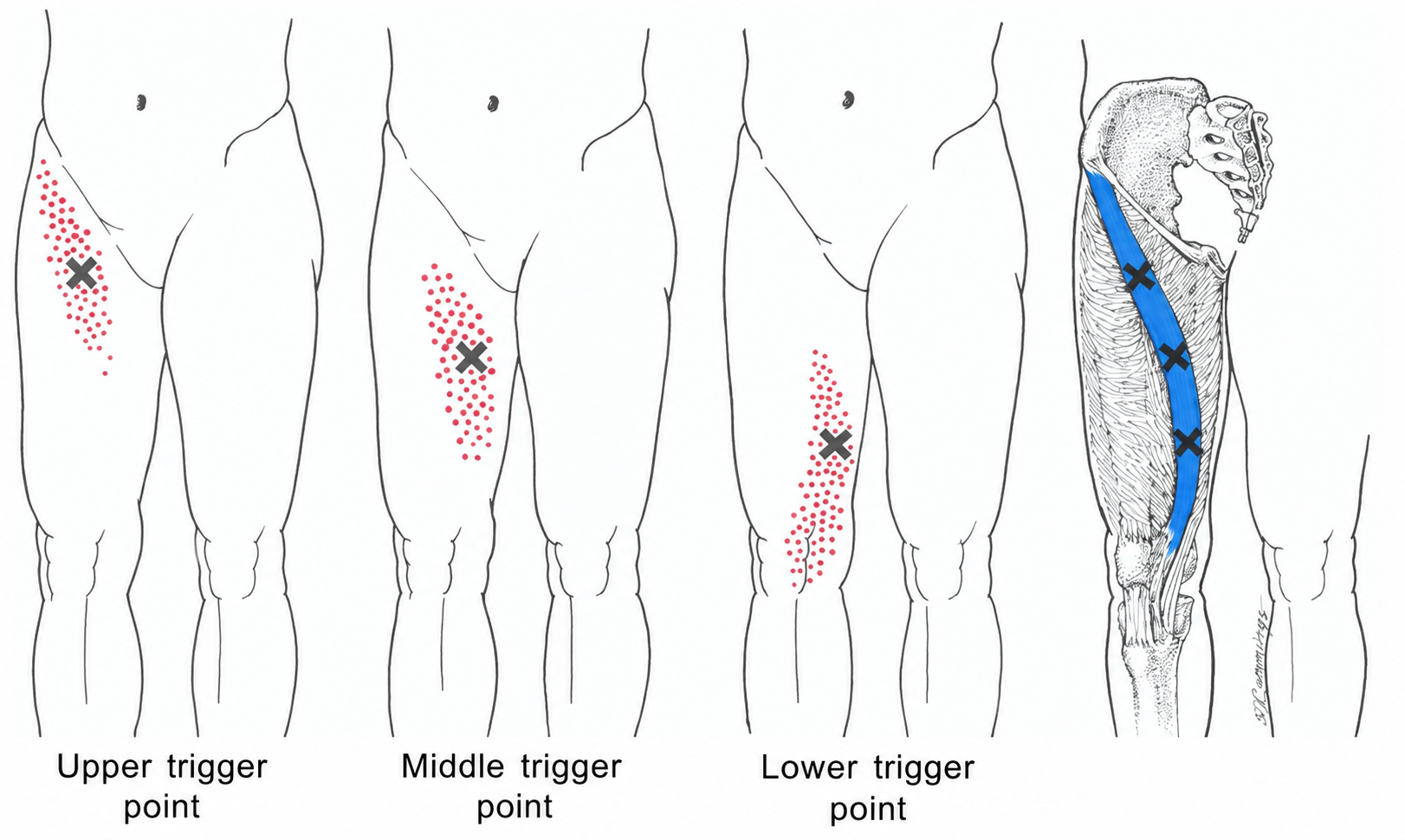Sartorius · Regional source example. Right sartorius: three separate source regions along the muscle, with distinct local pain fields. Travell and Simons, Fig. 12.6, p. 227. Regional illustration; not an individual map of a selected numbered point.