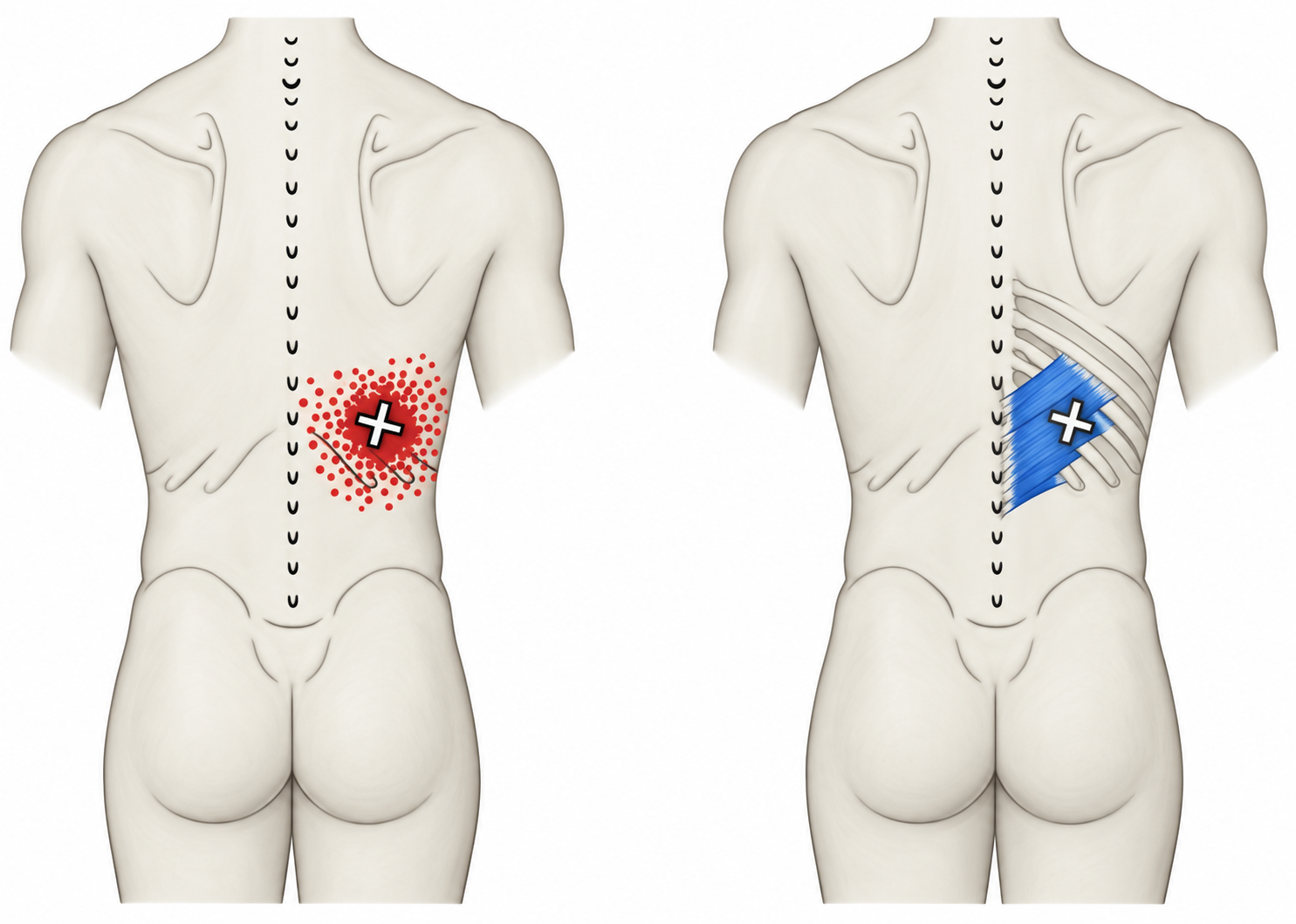 Serratus Posterior Inferior · Regional source example. Right serratus posterior inferior: the paired source anatomical and surface examples with the regional pain pattern. Travell and Simons, Fig. 47.7, p. 909. Regional illustration; not an individual map of a selected numbered point.