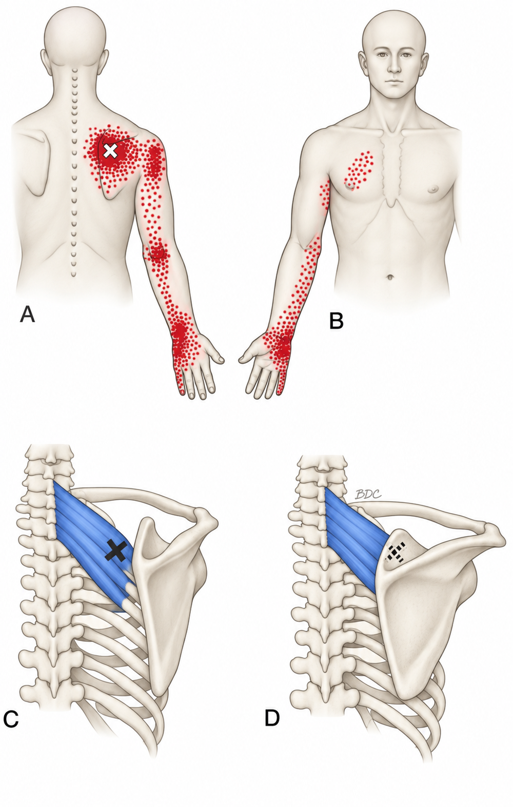 Serratus Posterior Superior · Regional source example. Right serratus posterior superior: anterior and posterior regional pain patterns. In C, scapular abduction exposes the marked region; D shows the same region beneath the scapula in its usual position, marked with a dashed X. Travell and Simons, Fig. 47.1, p. 901. Regional illustration; not an individual map of a selected numbered point.