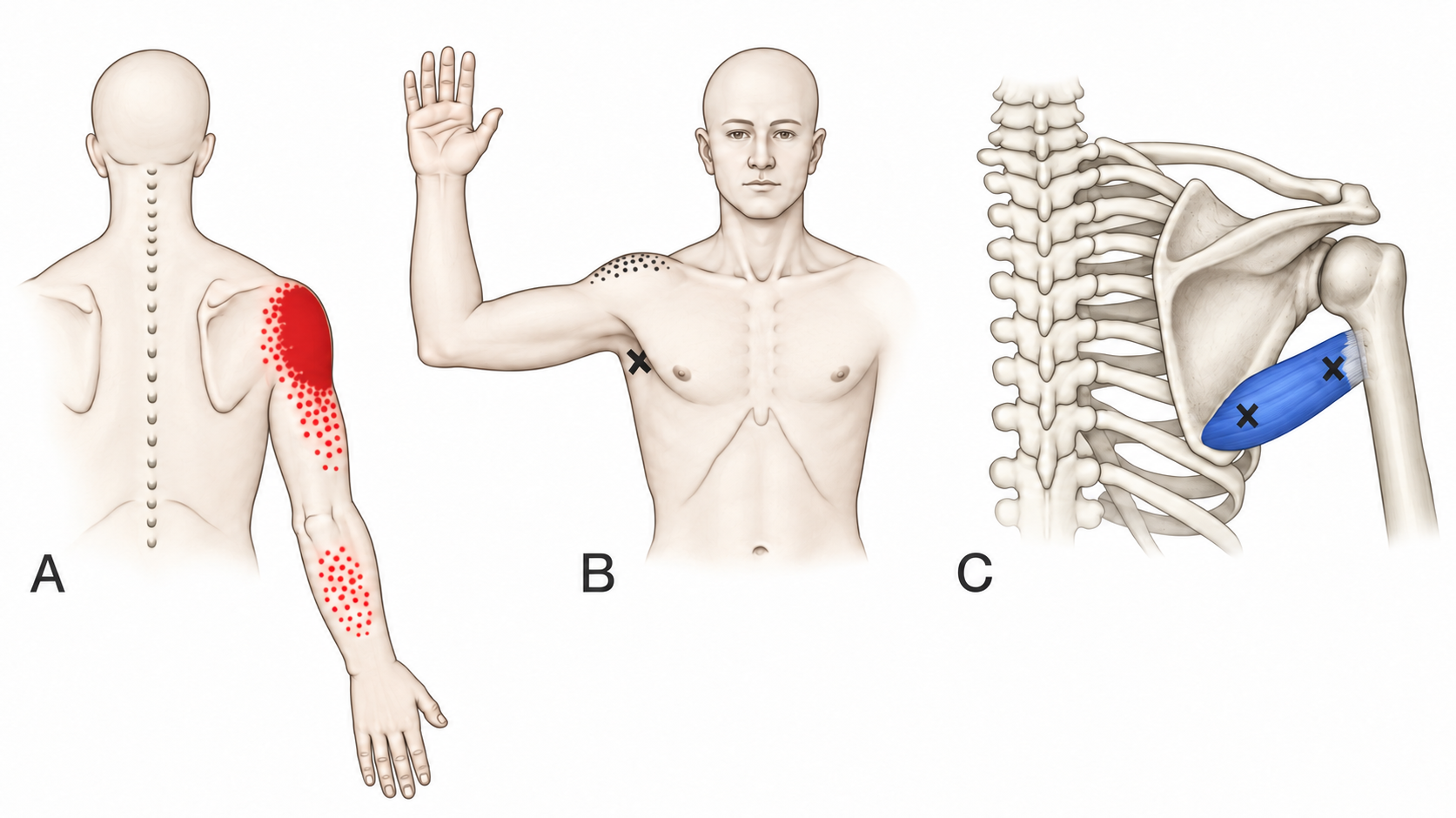Teres Major · Regional source example. Teres major: source anatomical and surface examples. Panel A uses red referral fields; panel B retains the original dark stippling. Travell and Simons, Fig. 25.1, p. 588. Regional illustration; not an individual map of a selected numbered point.