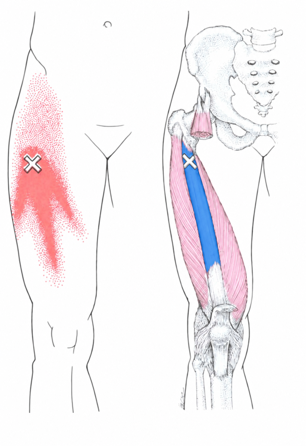 Vastus Intermedius · Regional source example. Right vastus intermedius: the source examples beneath the cut rectus femoris and their anterior-thigh pain pattern. Travell and Simons, Fig. 14.3, p. 252. Regional illustration; not an individual map of a selected numbered point.