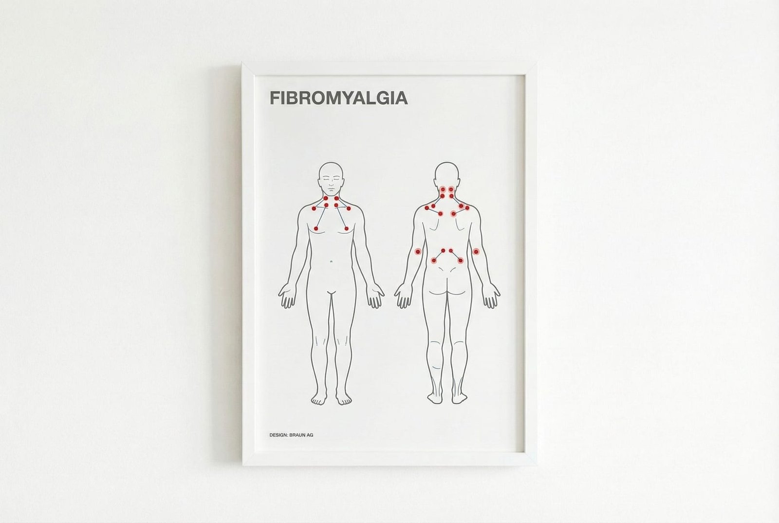 Fibromyalgie gegen MPS