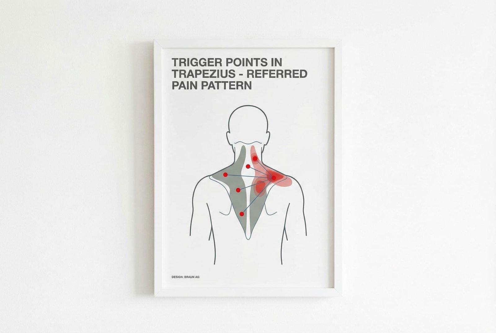 Referred Pain Map