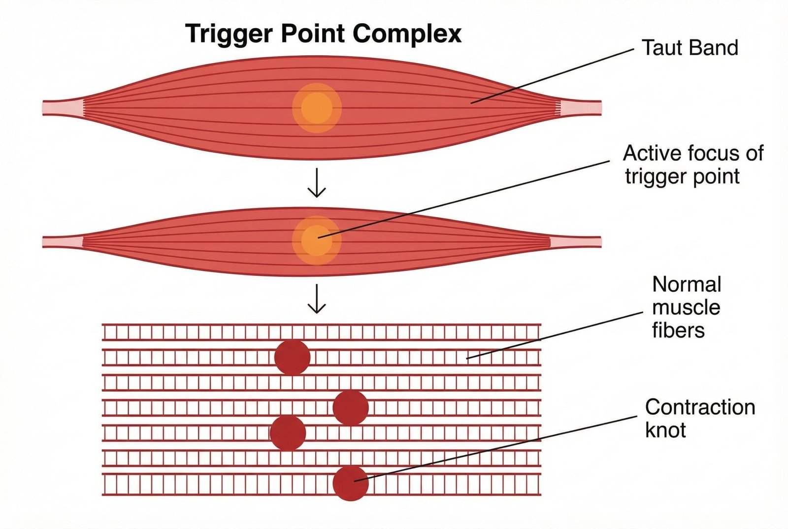 Taut Band Diagram